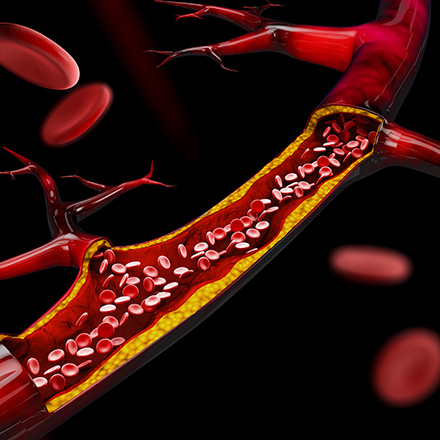 New Clinical Trial: Novel Treatment for Carotid Artery Disease