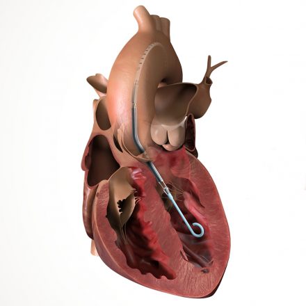 Mobile Learning Lab to showcase tiny Impella heart pump