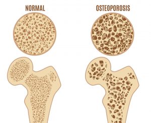 Osteoporosis - Monument Health