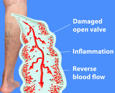 Treatment available for varicose veins