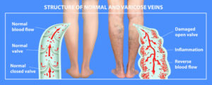 5 myths about varicose veins - FSA Vein